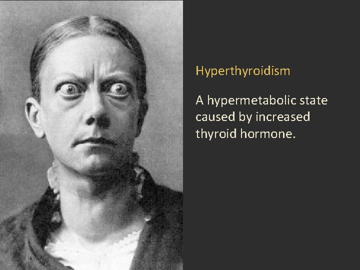 Hyperthyroidism A hypermetabolic state caused by increased thyroid hormone. Hyperthyroidism A hypermetabolic state caused by increased thyroid hormone.