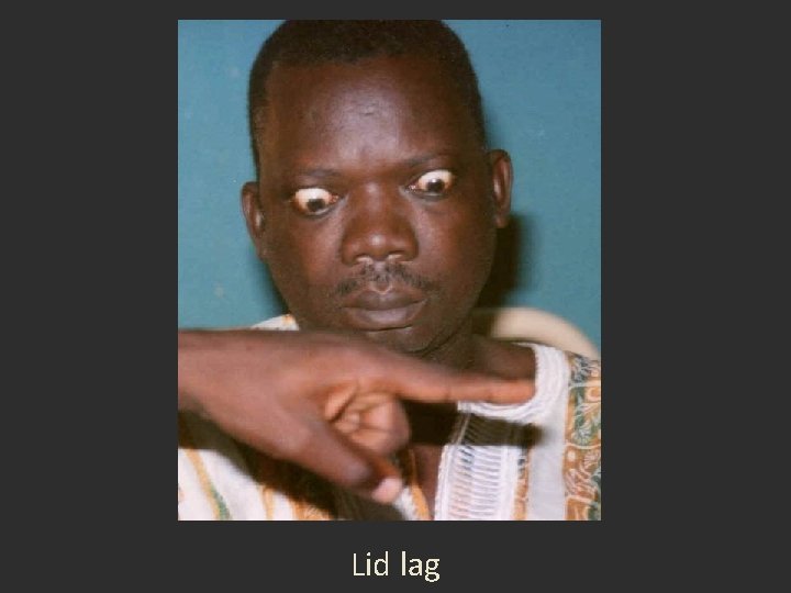 Lid lag Lid lag