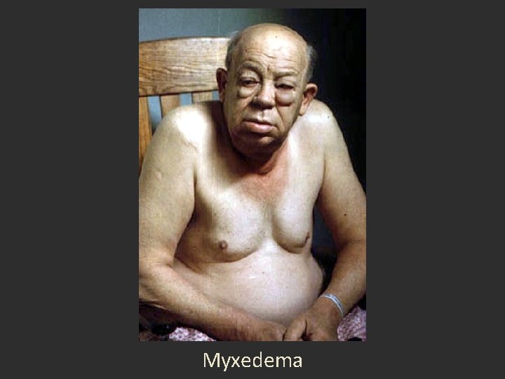 Myxedema Myxedema