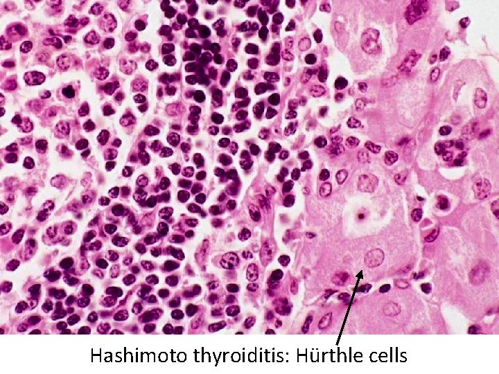 Hashimoto thyroiditis: Hürthle cells Hashimoto thyroiditis: Hürthle cells