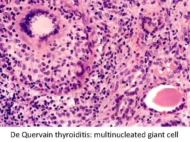 De Quervain thyroiditis: multinucleated giant cell De Quervain thyroiditis: multinucleated giant cell