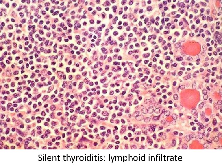 Silent thyroiditis: lymphoid infiltrate Silent thyroiditis: lymphoid infiltrate