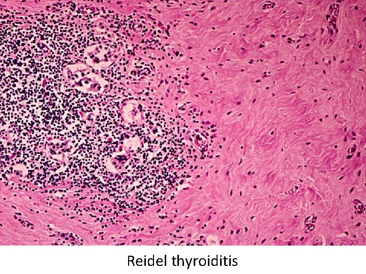 Reidel thyroiditis Reidel thyroiditis