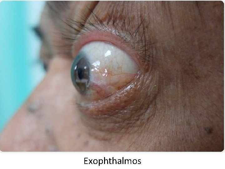 Exophthalmos Exophthalmos