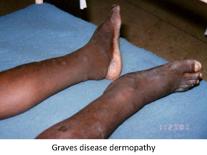 Graves disease dermopathy Graves disease dermopathy