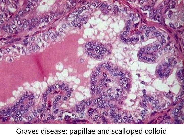 Graves disease: papillae and scalloped colloid Graves disease: papillae and scalloped colloid