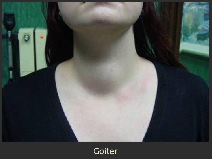Goiter Goiter
