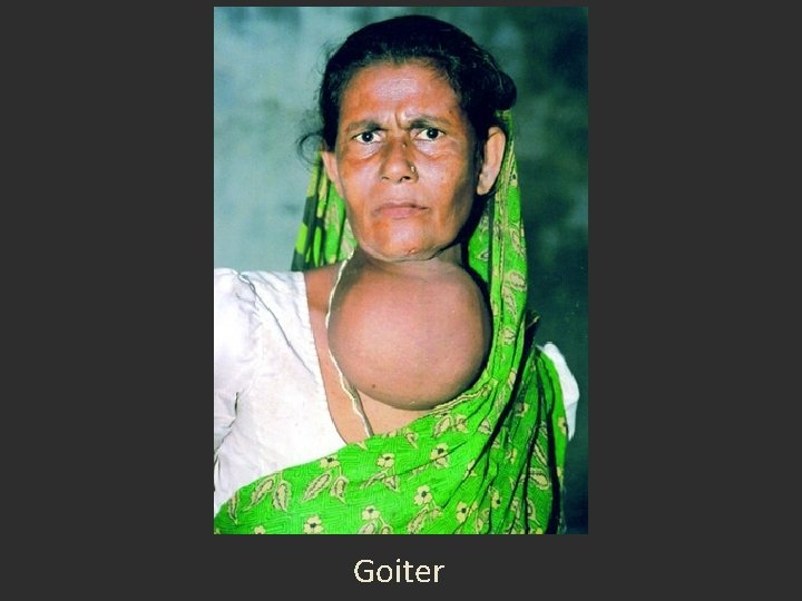 Goiter Goiter