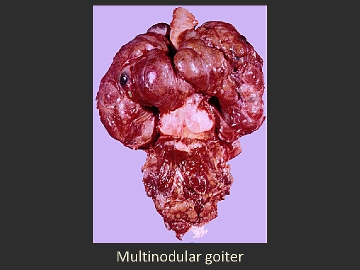Multinodular goiter Multinodular goiter