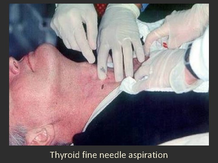 Thyroid fine needle aspiration Thyroid fine needle aspiration