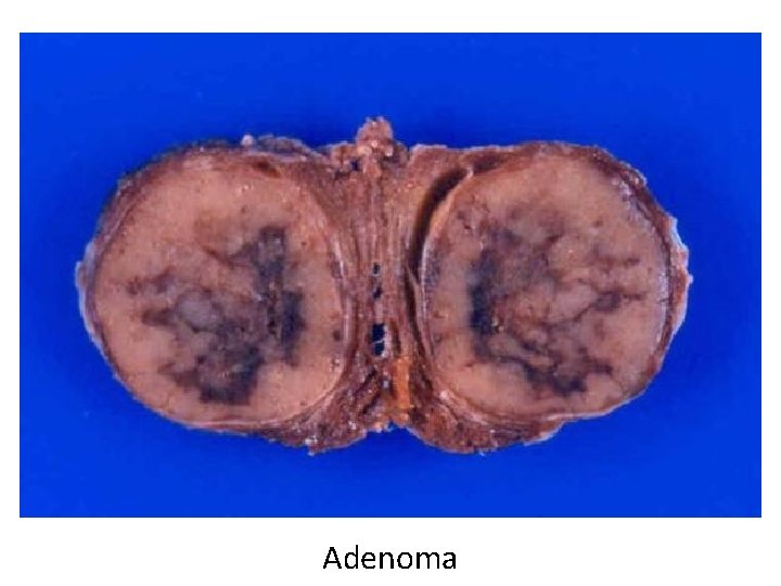 Adenoma Adenoma
