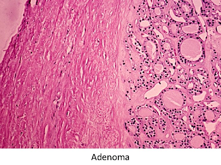 Adenoma Adenoma
