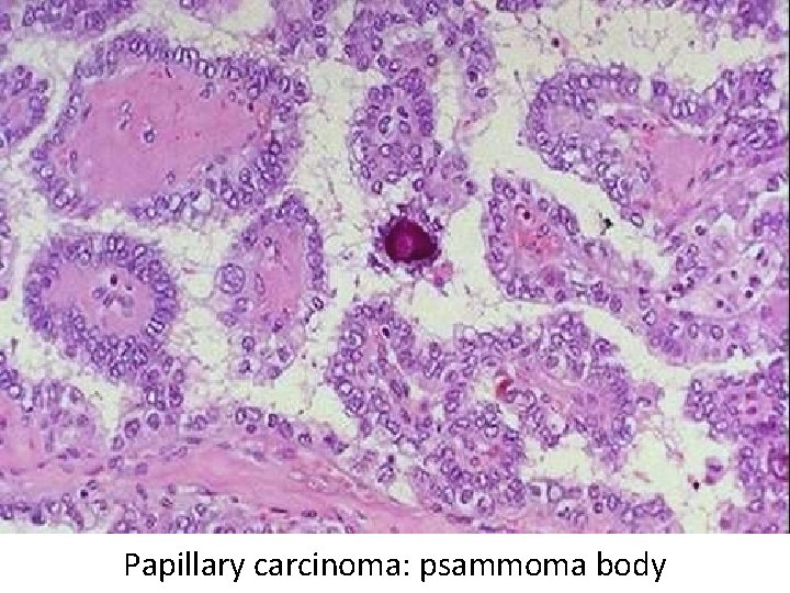 Papillary carcinoma: psammoma body Papillary carcinoma: psammoma body