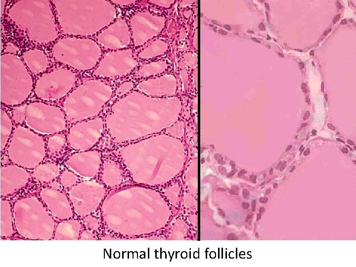Normal thyroid follicles Normal thyroid follicles