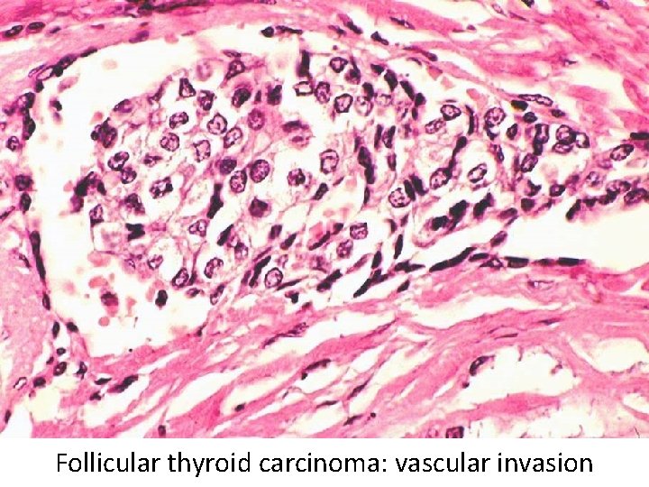 Follicular thyroid carcinoma: vascular invasion Follicular thyroid carcinoma: vascular invasion