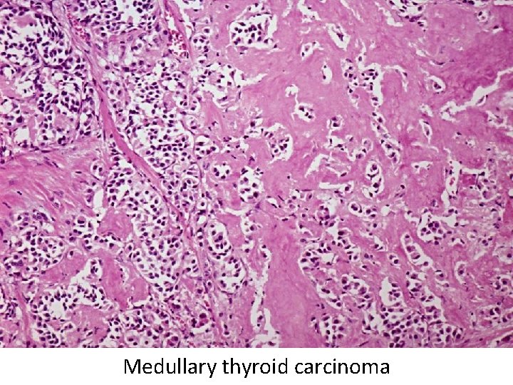 Medullary thyroid carcinoma Medullary thyroid carcinoma