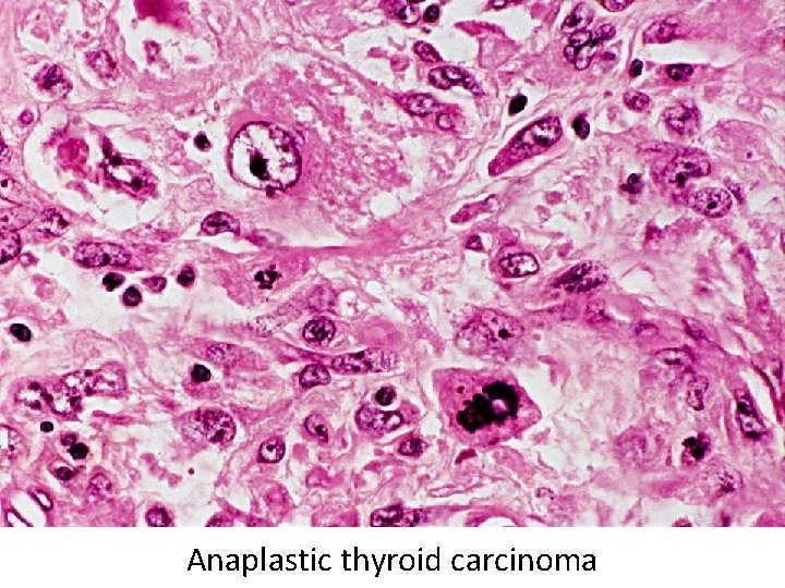 Anaplastic thyroid carcinoma Anaplastic thyroid carcinoma