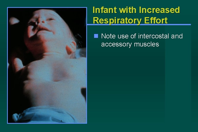 Infant with Increased Respiratory Effort Note use of intercostal and accessory muscles 