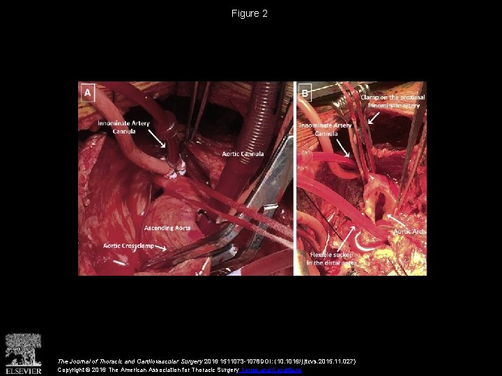 Figure 2 The Journal of Thoracic and Cardiovascular Surgery 2016 1511073 -1078 DOI: (10.