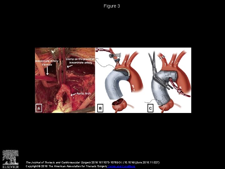 Figure 3 The Journal of Thoracic and Cardiovascular Surgery 2016 1511073 -1078 DOI: (10.