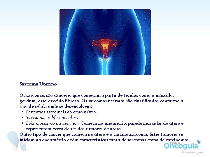 Sarcoma Uterino Os sarcomas são cânceres que começam a partir de tecidos como o Sarcoma Uterino Os sarcomas são cânceres que começam a partir de tecidos como o