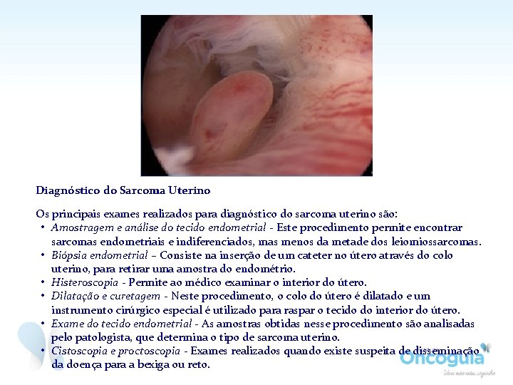 Diagnóstico do Sarcoma Uterino Os principais exames realizados para diagnóstico do sarcoma uterino são: Diagnóstico do Sarcoma Uterino Os principais exames realizados para diagnóstico do sarcoma uterino são: