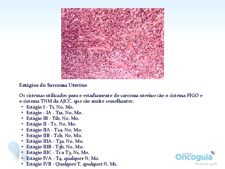 Estágios do Sarcoma Uterino Os sistemas utilizados para o estadiamento do sarcoma uterino são Estágios do Sarcoma Uterino Os sistemas utilizados para o estadiamento do sarcoma uterino são