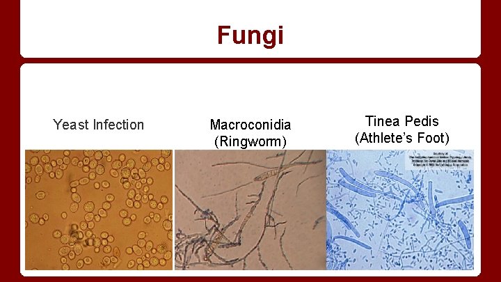 Fungi Yeast Infection Macroconidia (Ringworm) Tinea Pedis (Athlete’s Foot) 