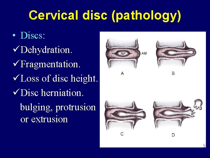 Cervical disc (pathology) • Discs: üDehydration. üFragmentation. üLoss of disc height. üDisc herniation. bulging,