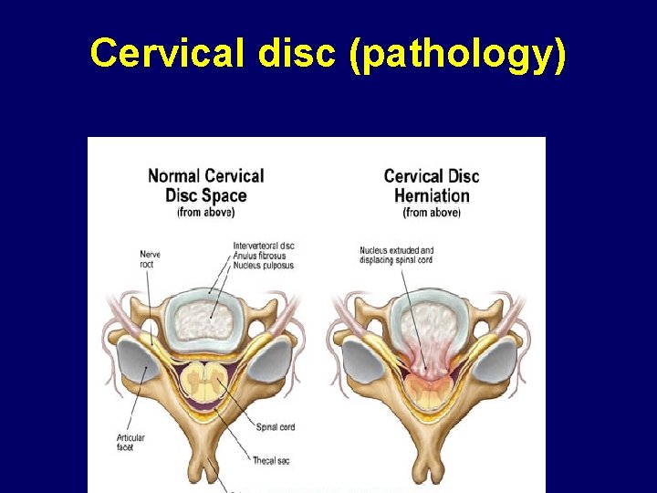Cervical disc (pathology) 