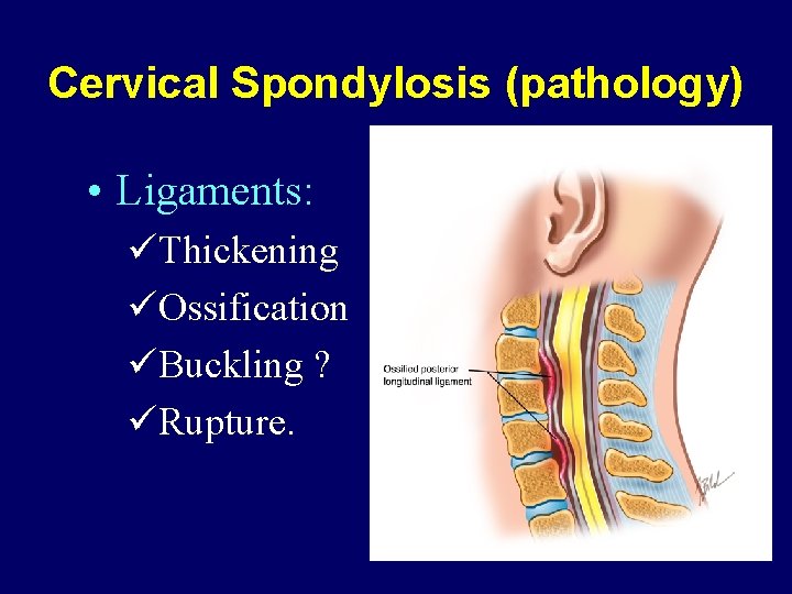 Cervical Spondylosis (pathology) • Ligaments: üThickening üOssification üBuckling ? üRupture. 