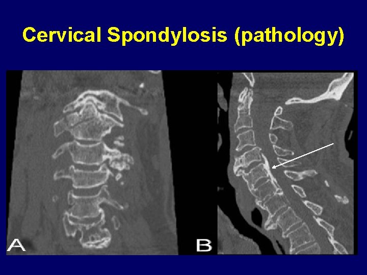 Cervical Spondylosis (pathology) 