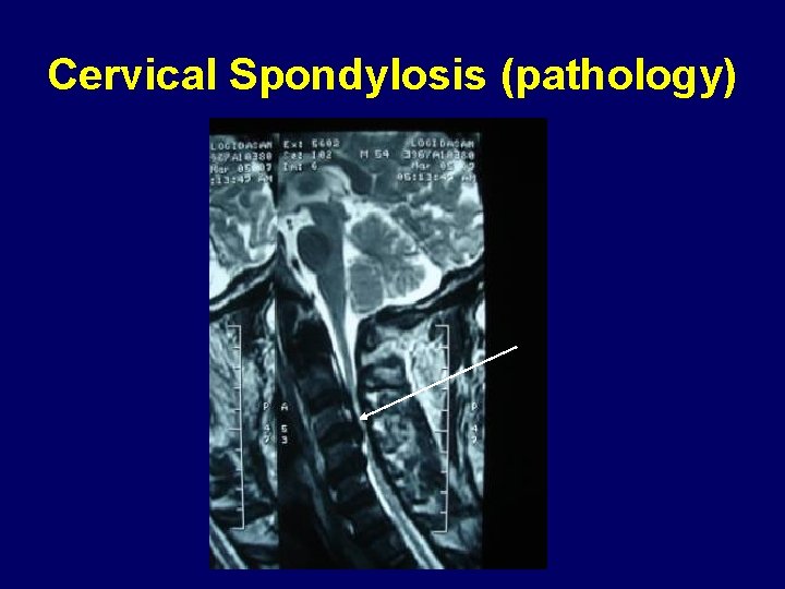 Cervical Spondylosis (pathology) 