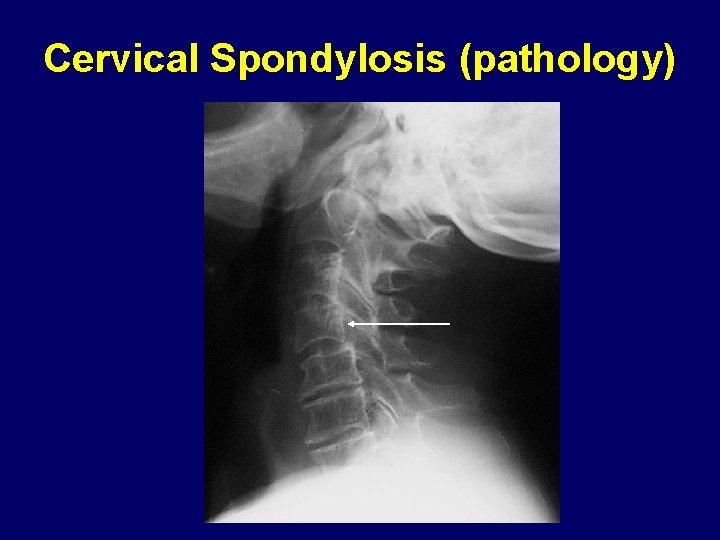 Cervical Spondylosis (pathology) 