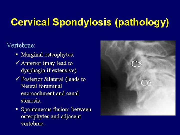 Cervical Spondylosis (pathology) Vertebrae: § Marginal osteophytes: ü Anterior (may lead to dysphagia if