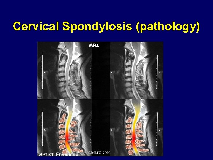 Cervical Spondylosis (pathology) 