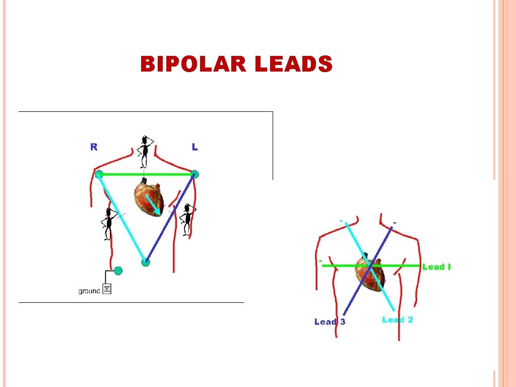 BIPOLAR LEADS 
