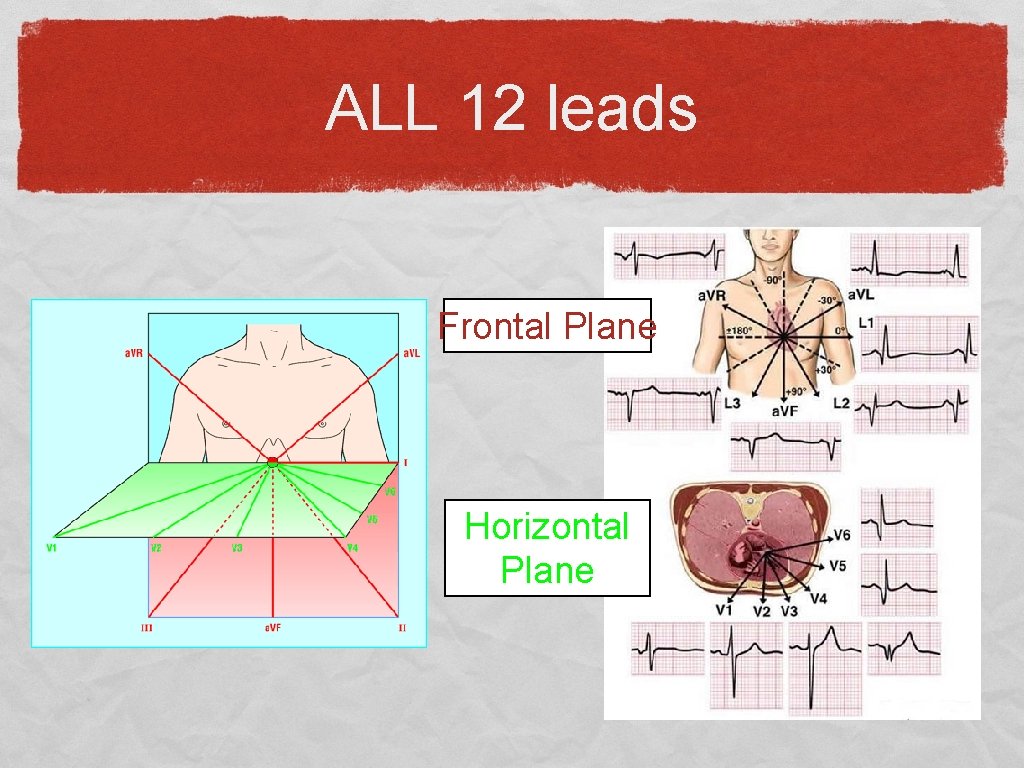 ALL 12 leads Frontal Plane Horizontal Plane 