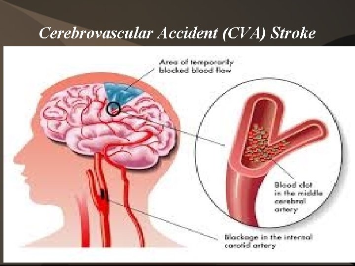 Cerebrovascular Accident (CVA) Stroke 74 