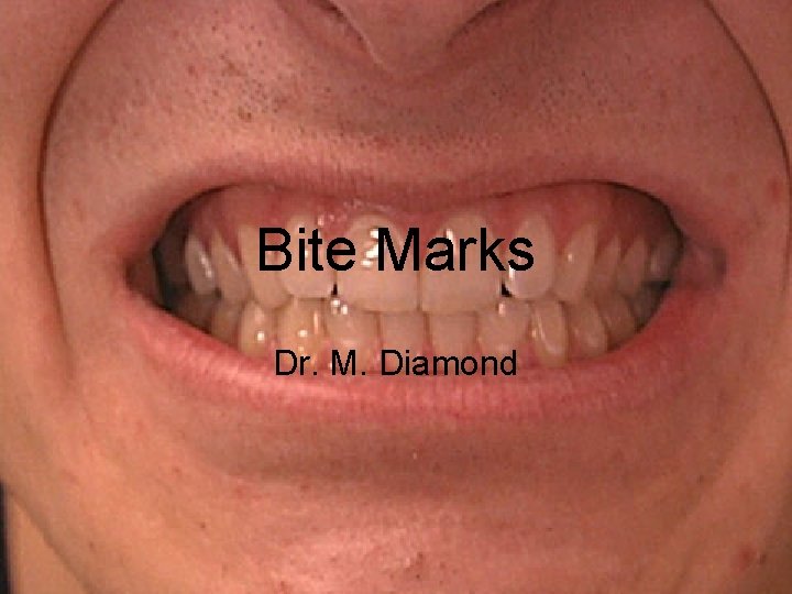 Bite Marks Dr. M. Diamond 