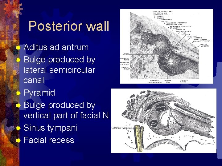 Posterior wall ® Aditus ad antrum ® Bulge produced by lateral semicircular canal ®