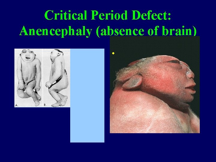 Critical Period Defect: Anencephaly (absence of brain) • 