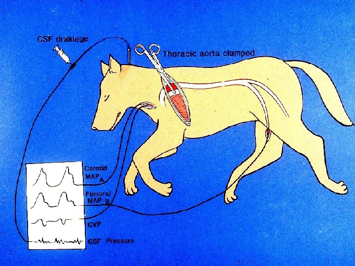 Thoracoabdominal Aortic Aneurysms 