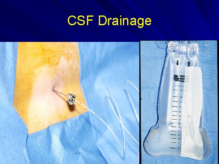 CSF Drainage 