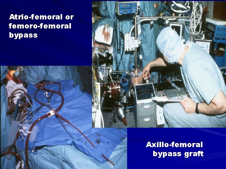 Atrio-femoral or femoro-femoral bypass Axillo-femoral bypass graft 