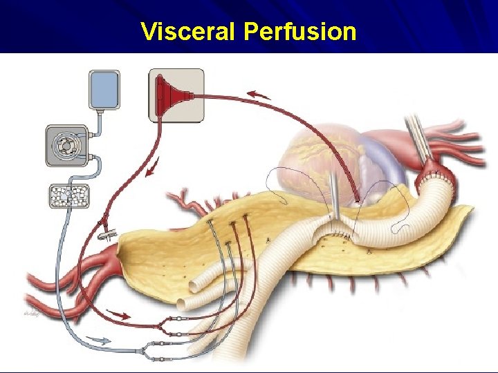 Visceral Perfusion 