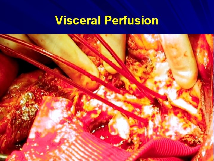 Visceral Perfusion 