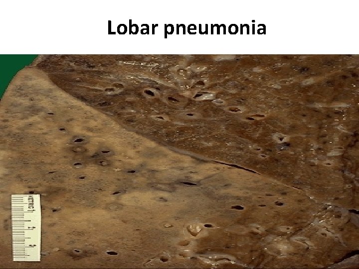 Lobar pneumonia Lobar pneumonia