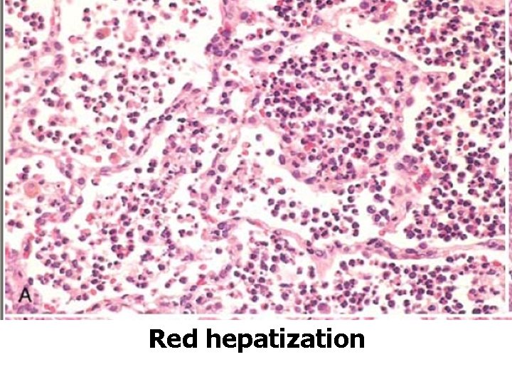 Red hepatization Red hepatization