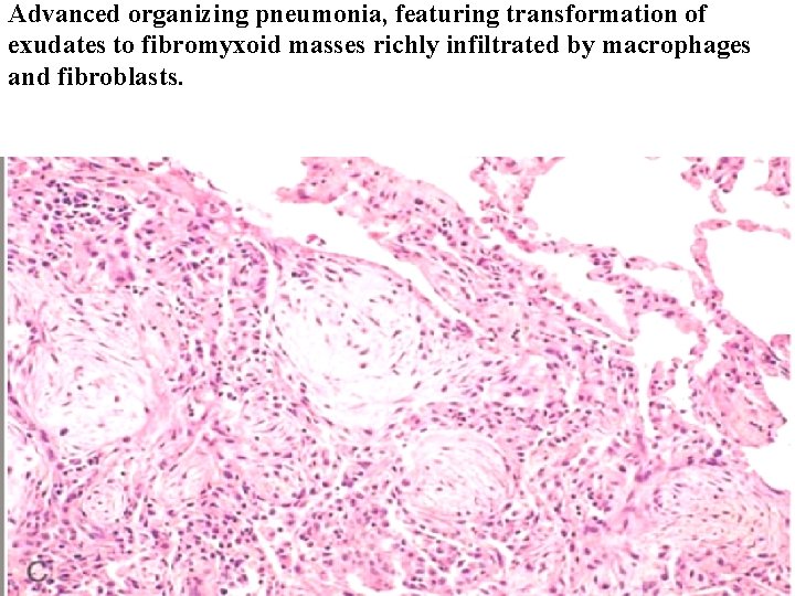 Advanced organizing pneumonia, featuring transformation of exudates to fibromyxoid masses richly infiltrated by macrophages Advanced organizing pneumonia, featuring transformation of exudates to fibromyxoid masses richly infiltrated by macrophages
